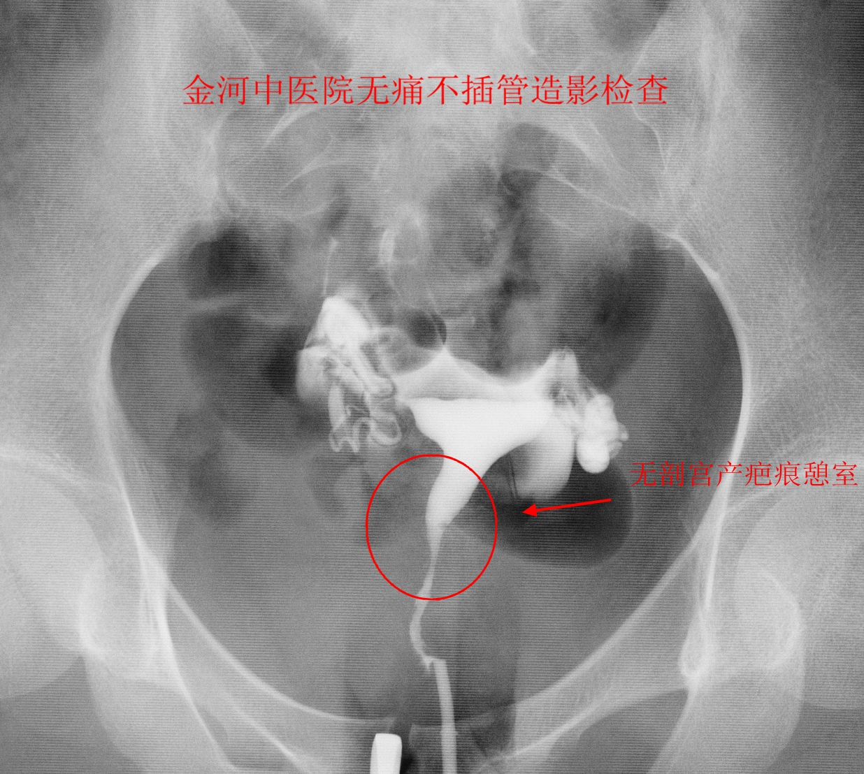 月经淋漓不尽,罪魁祸首可能是剖宫产疤痕憩室?