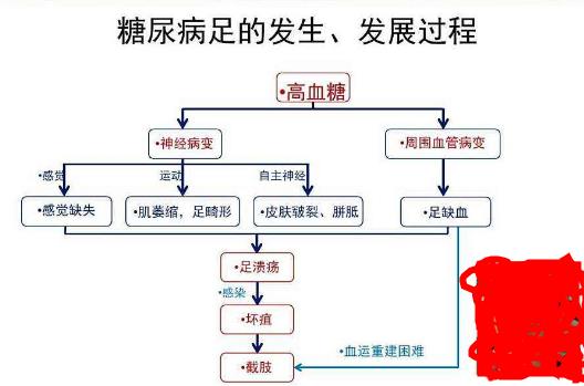 医院什么科室治疗糖尿病足效果好?