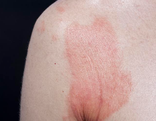 4,接触性荨麻疹临床上还有一种叫做接触性寻麻疹的皮肤疾病,也是属于