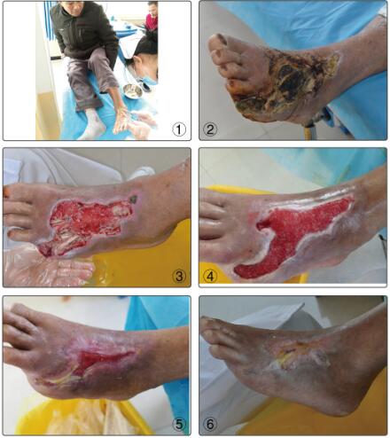 伤口结痂过程图图片