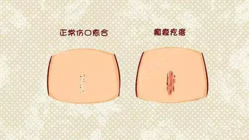 露肉的季节,那些丑陋的"瘢痕"怎么藏?